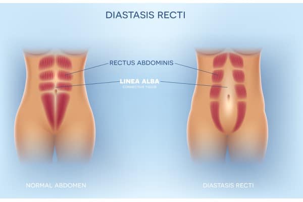 What Non-Surgical Options Are Available for Diastasis Recti Uppingham?