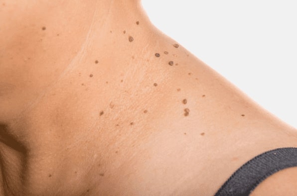 Are you looking for easy skin tag removal Uppingham - then contact Spire today!