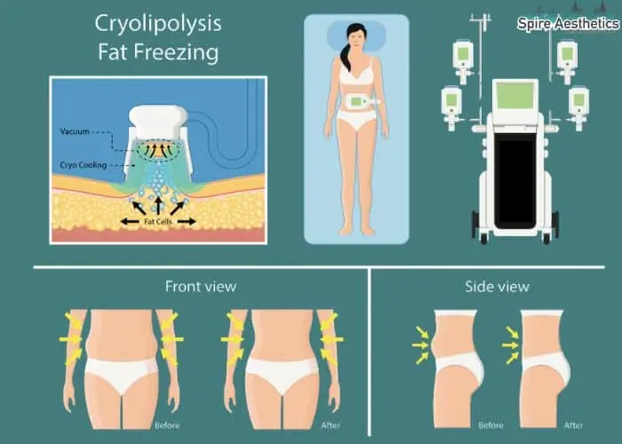 Fat freezing treatment Uppingham benefits for competitions to remove stubborn fat deposits.