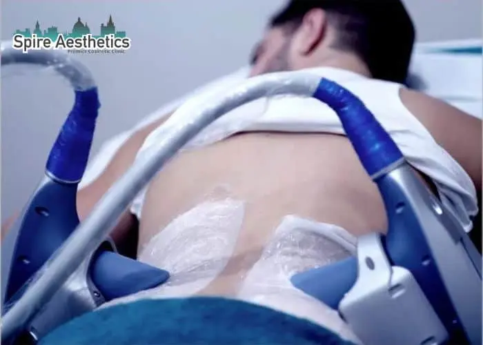 Man having fat freezing treatment done on love handles before a competitions Uppingham to create a sculpted look.