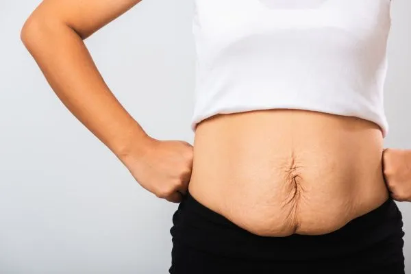 Image of a woman's stomach after weight loss with sagging skin following a gastric band Uppingham